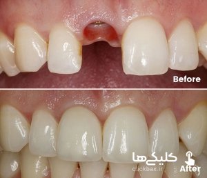 dental-implant-960w-300x258.jpg